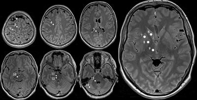 Cerebral Microstructural Alterations in Patients With Early Parkinson’s Disease Detected With Quantitative Magnetic Resonance Measurements